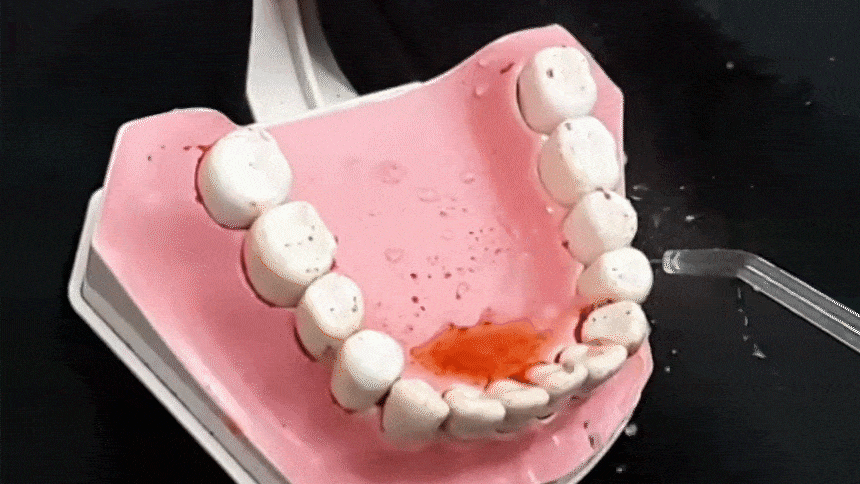 치아에 껴있는 고추가루 세정하는 영상